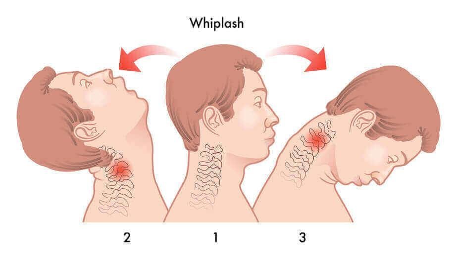 whiplash